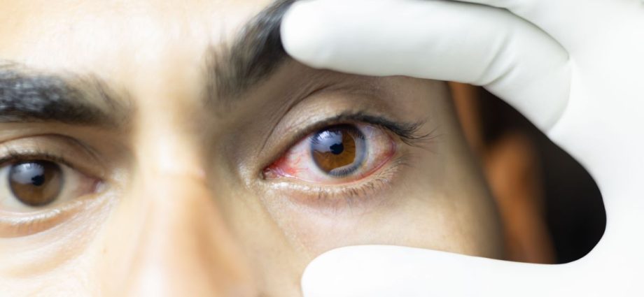 ACANTHAMOEBA: RISCOS E PREVENÇÃO EM LENTES DE CONTATO