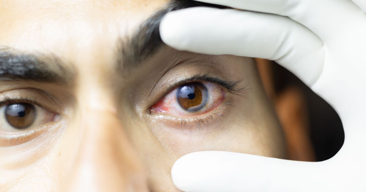 ACANTHAMOEBA: RISCOS E PREVENÇÃO EM LENTES DE CONTATO