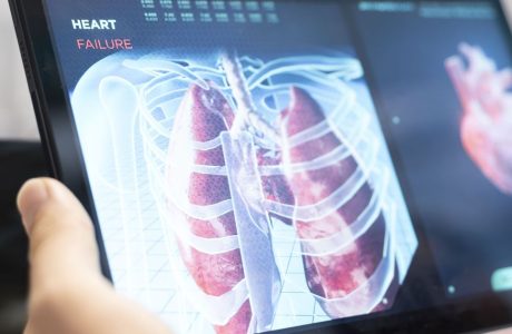 PULMÕES ARTIFICIAIS: MARCO NA MEDICINA MODERNA